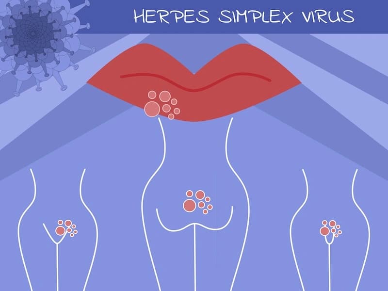 Herpes genital: análisis de la lesión (PCR) y serología