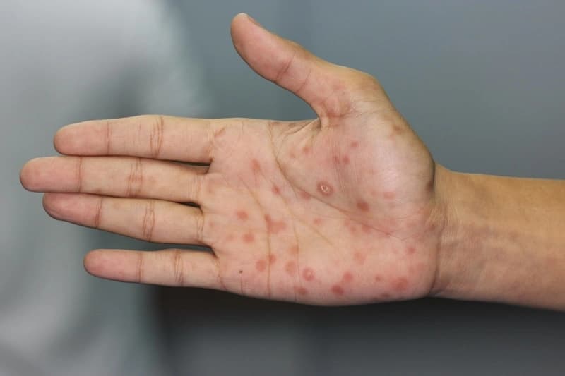 Sífilis: análisis de sangre, VDRL, FTA-ABS y tratamiento