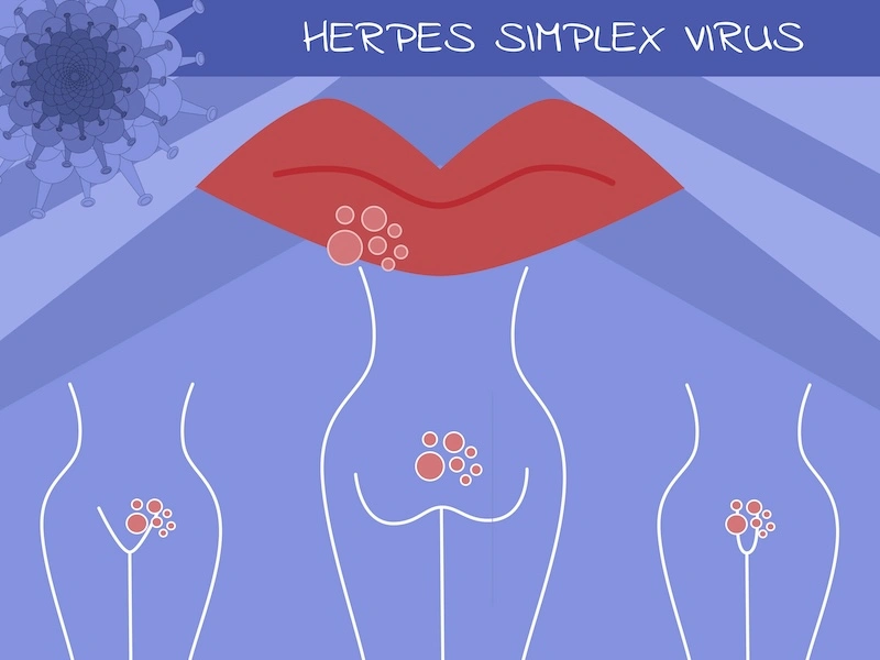 herpes Laboratorio Aclimu Herpes Laboratorio Aclimu